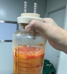 辽源水动力吸脂手术要做多久？